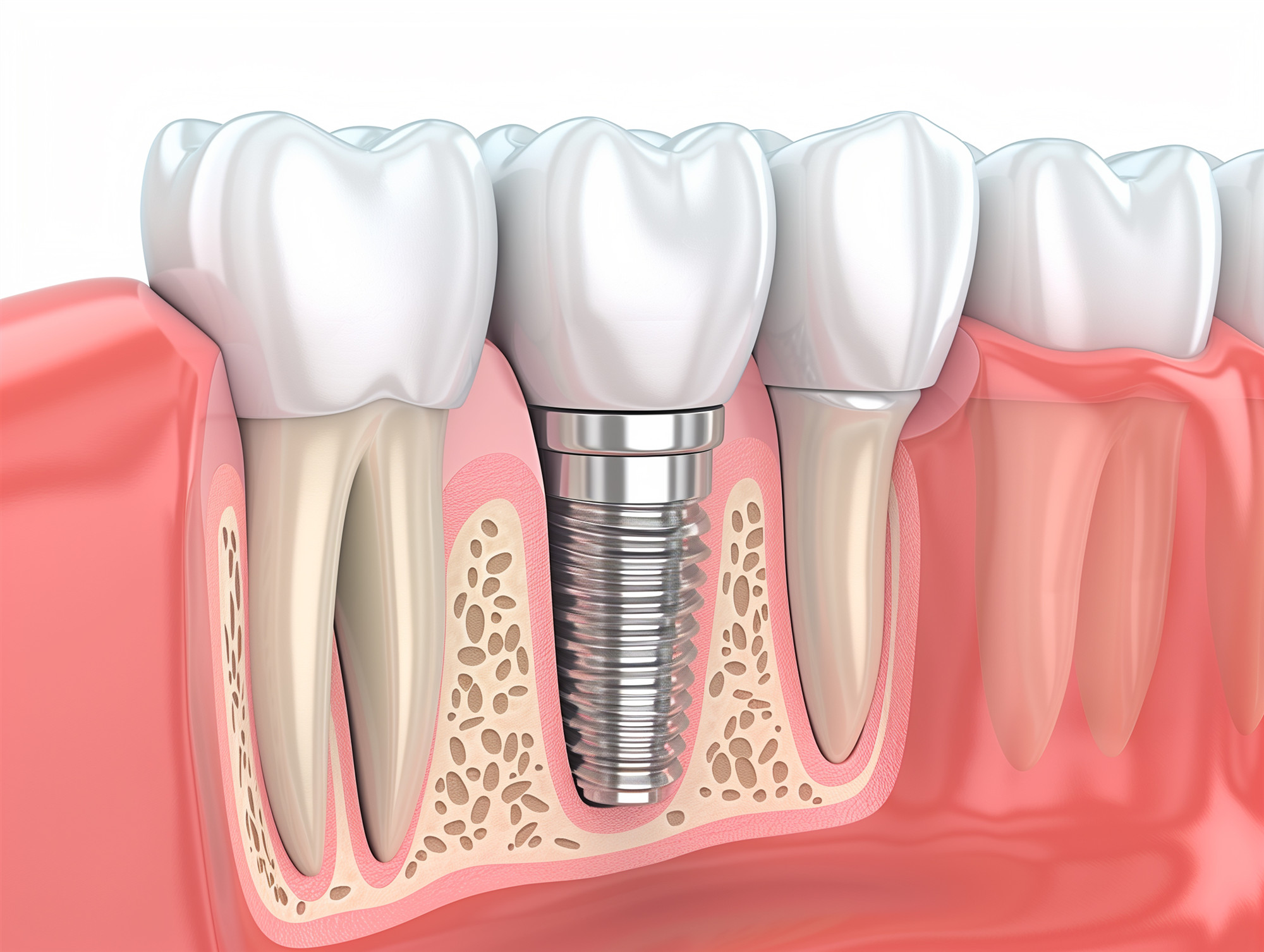 Am I a Candidate for Dental Implants?